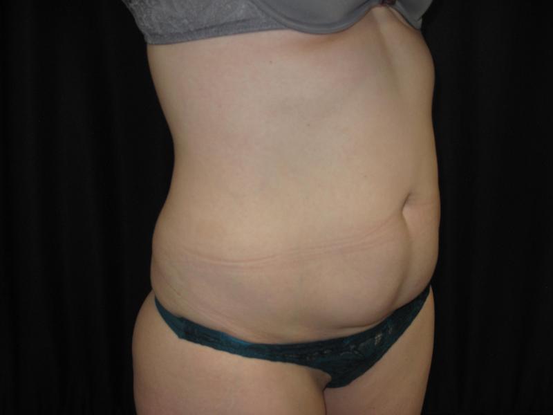 Dr. Mark Walker MD - Body - Tummy Tucks (Abdominoplasty)- Binghamton NY